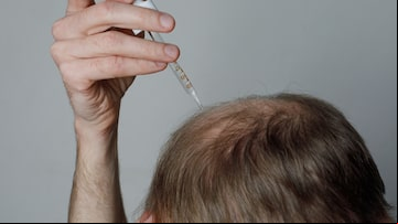 Hair loss problem. Man applying dropper with minoxidil or serum. Baldness treatment and alopecia concept. Foto: millaf/Adobe Stock